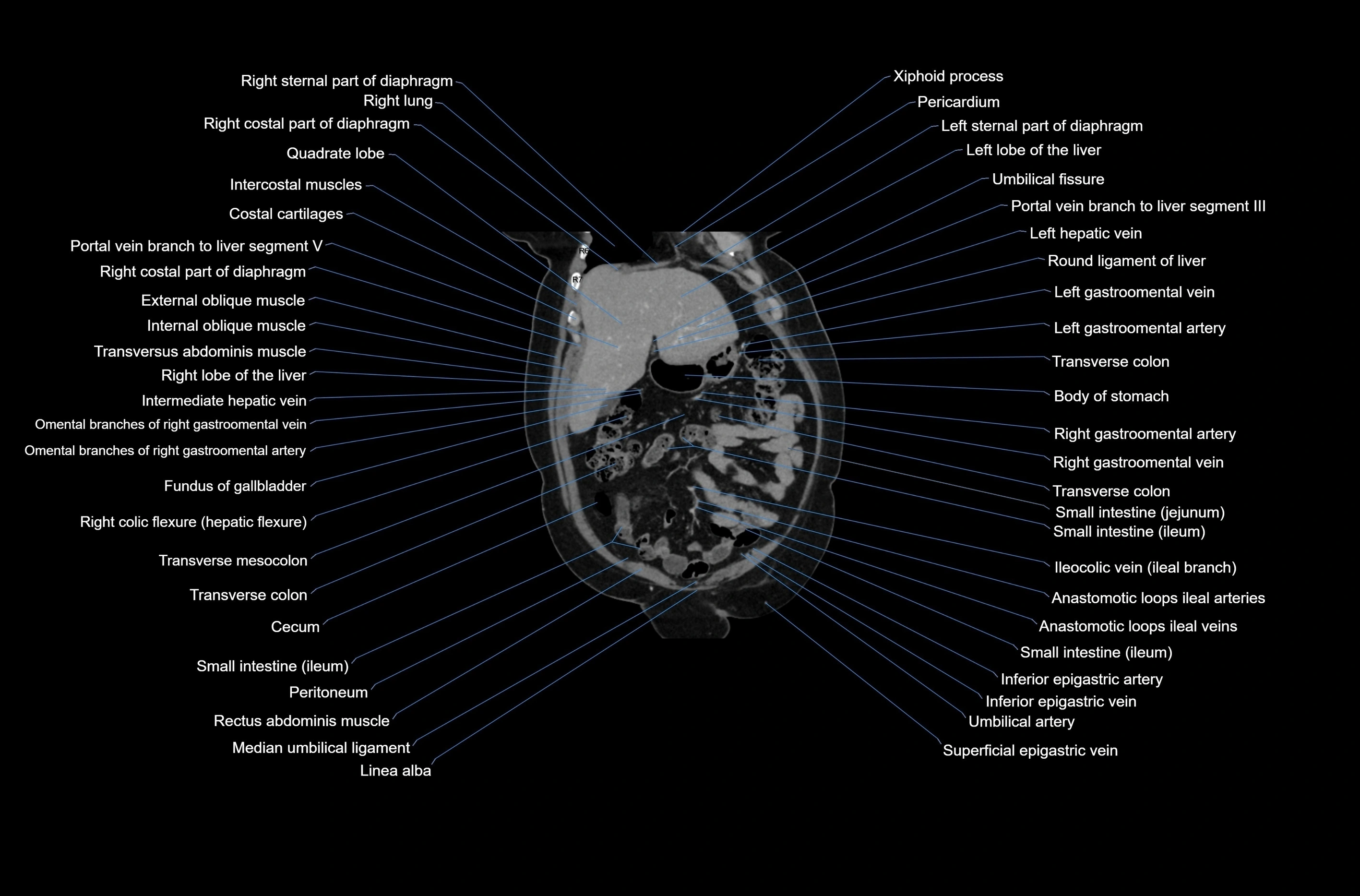 CT abdomen coronal cross sectional anatomy labelled radiology image-00019.webp